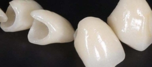Коронки на передние зубы — стоматология «Премьера» ☎ +7 (812) 309-00-52