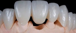 Мостовидные протезы на передние зубы — стоматология «Премьера» ☎ +7 (812) 309-00-52