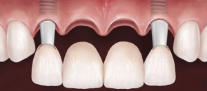 Протезирование передних зубов на имплантах — стоматология «Премьера» ☎ +7 (812) 309-00-52