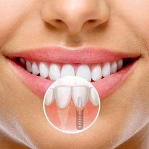 Протезирование передних зубов под ключ — стоматология «Премьера» ☎ +7 (812) 309-00-52 СПб
