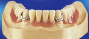 Бюгельное протезирование передних зубов — стоматология «Премьера» ☎ +7 (812) 309-00-52