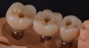 Импланты на жевательные зубы в СПб недорого — «Премьера» ☎ +7 (812) 309-00-52