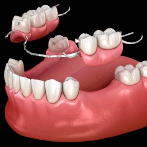 Протезирование жевательных зубов в СПб недорого — стоматология «Премьера» ☎ +7 (812) 309-00-52
