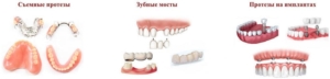 Восстановление жевательных зубов в СПб под ключ — стоматология «Премьера» ☎ +7 (812) 309-00-52