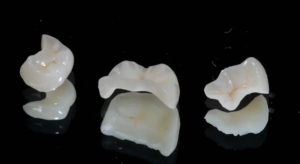 Протезирование жевательных зубов зубными вкладками в СПб — стоматология «Премьера» ☎ +7 (812) 309-00-52