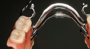 Бюгельное протезирование жевательных зубов в СПб — стоматология «Премьера» ☎ +7 (812) 309-00-52