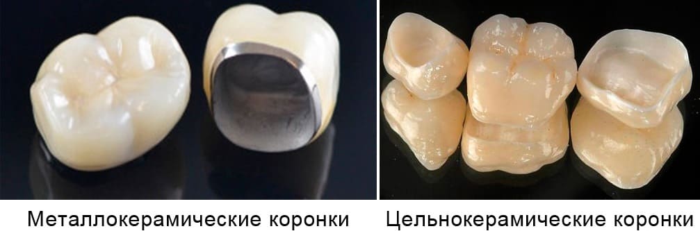 Протезирование зубов коронками в СПб под ключ — стоматология «Премьера» ☎ +7 (812) 309-00-52