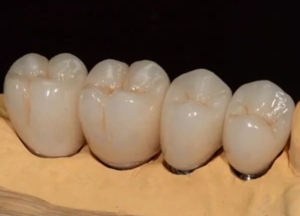 Цельноциркониевые зубные коронки в СПб — стоматология «Премьера» ☎ +7 (812) 309-00-52