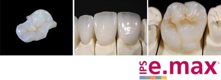 Керамические зубные коронки E-MAX недорого — «Премьера» ☎ +7 (812) 309-00-52 Петергофское шоссе 53