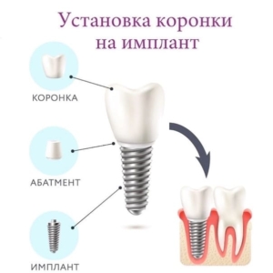Установка коронки на имплант в СПб недорого — стоматология «Премьера» ☎ +7 (812) 309-00-52