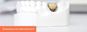 Зубные коронки на имплантатах в СПб недорого — «Премьера» ☎ +7 (812) 309-00-52