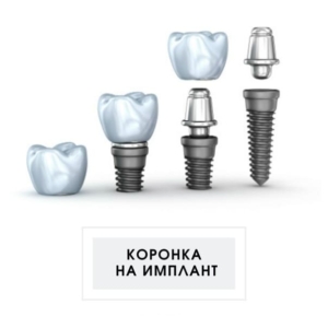 Зубные коронки на имплантах под ключ в СПб — «Премьера» ☎ +7 (812) 309-00-52