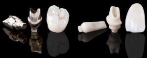 Зубные коронки на имплантатах под ключ — стоматология «Премьера» ☎ +7 (812) 309-00-52