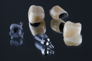 Коронка из металлокерамики на импланте — стоматология «Премьера» ☎ +7 (812) 309-00-52