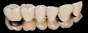 Зубные коронки из металлокерамики в СПб недорого — «Премьера» ☎ +7 (812) 309-00-52