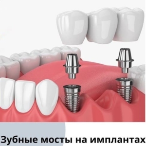 Зубной мост на имплантах в СПб недорого — «Премьера» ☎ +7 (812) 309-00-52