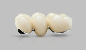 Зубной мост из металлокерамики — стоматология «Премьера» ☎ +7 (812) 309-00-52