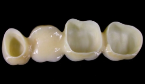 Мостовидный протез из керамики — стоматология «Премьера» ☎ +7 (812) 309-00-52