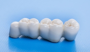 Зубной мост из диоксида циркония — стоматология «Премьера» ☎ +7 (812) 309-00-52