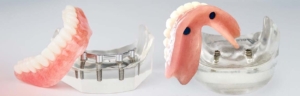 Полное протезирование зубов на имплантах в СПб — стоматология «Премьера» ☎ +7 (812) 309-00-52 