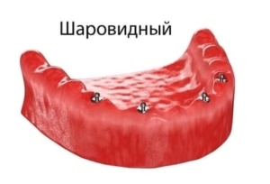 Протез на шаровидных абатментах — стоматология «Премьера» ☎ +7 (812) 309-00-52