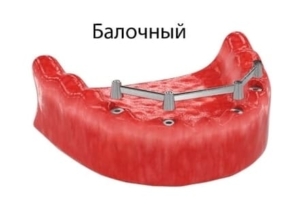 Балочный протез на имплантах — стоматология «Премьера» ☎ +7 (812) 309-00-52