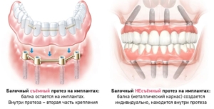 Полные покрывные протезы на имплантах в СПб — стоматология «Премьера» ☎ +7 (812) 309-00-52